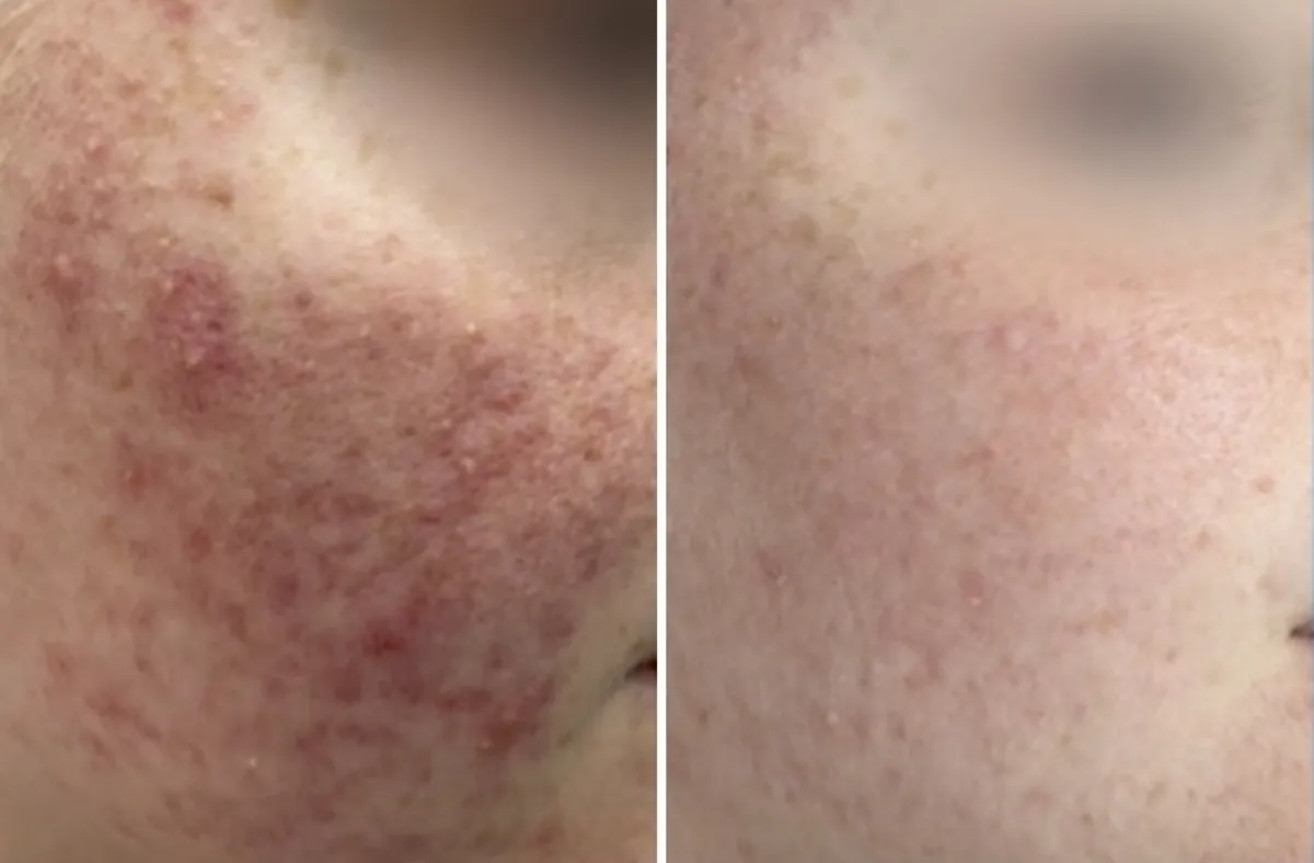 Client skin before and after treatment at All Things Beauty, Baldivis (3)
