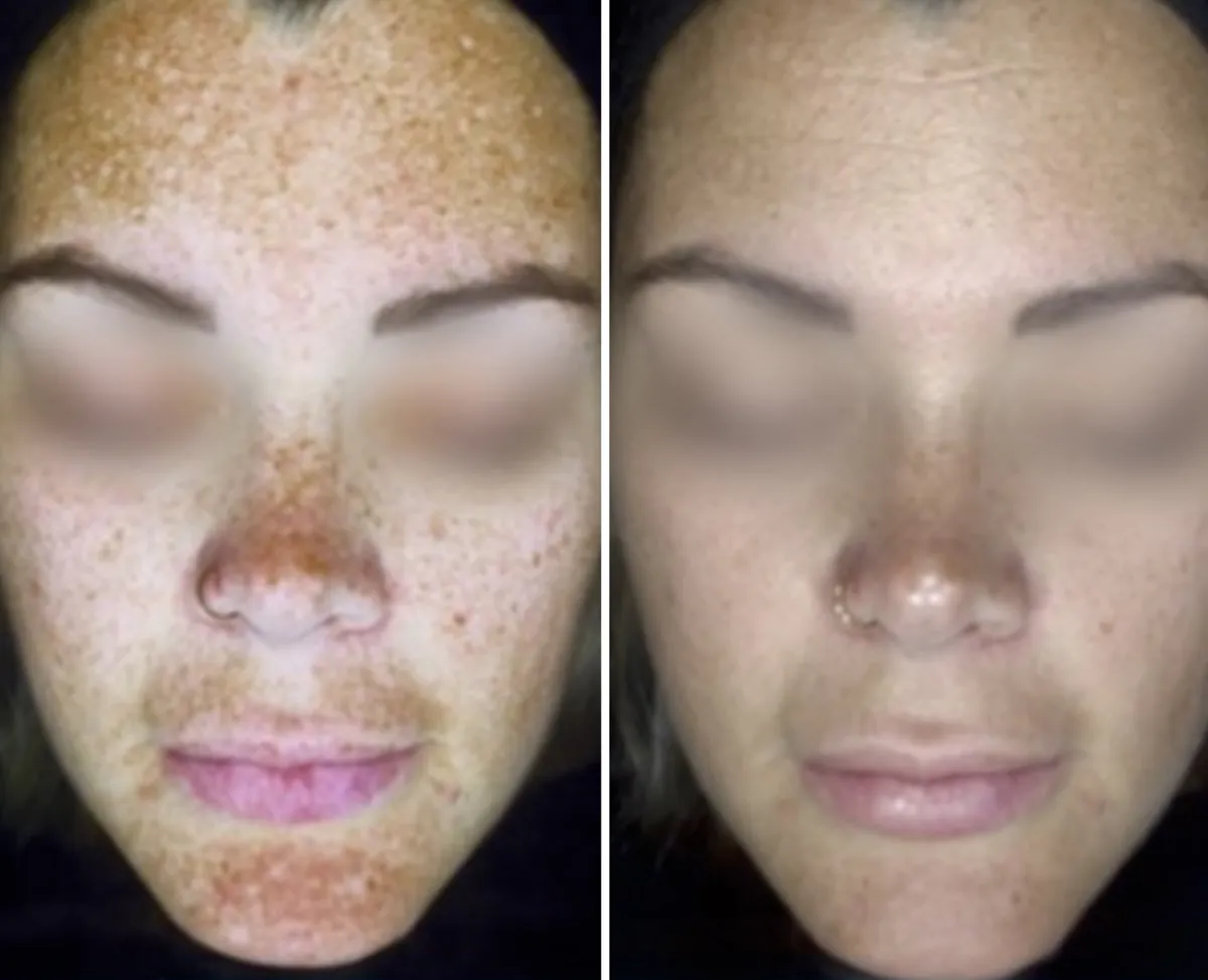 Client skin before and after treatment at All Things Beauty, Baldivis (1)