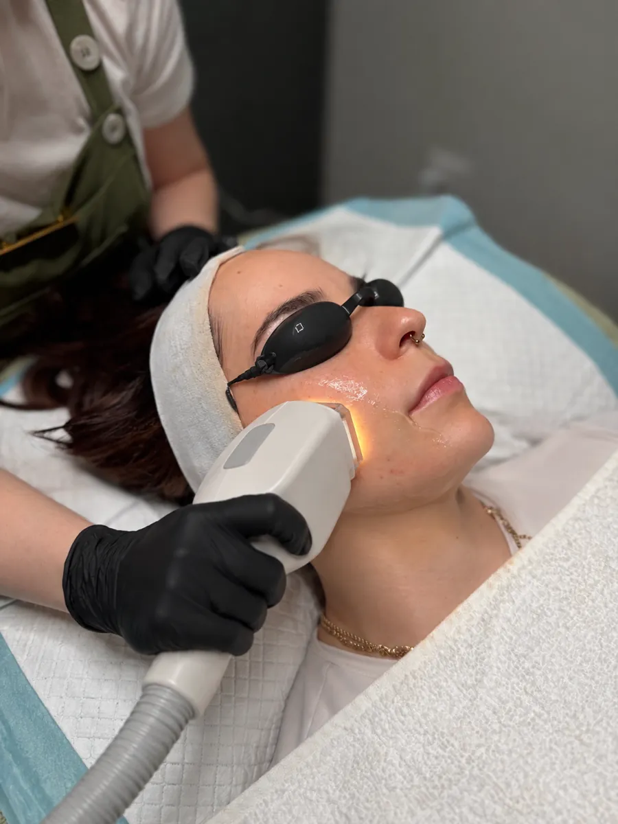 IPL at All Things Beauty, Baldivis Perth