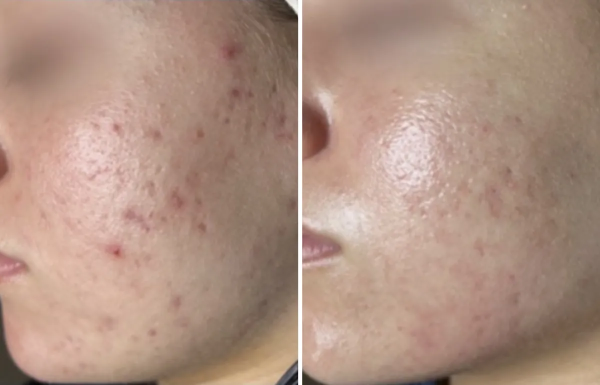 Client skin before and after treatment at All Things Beauty, Baldivis (2)